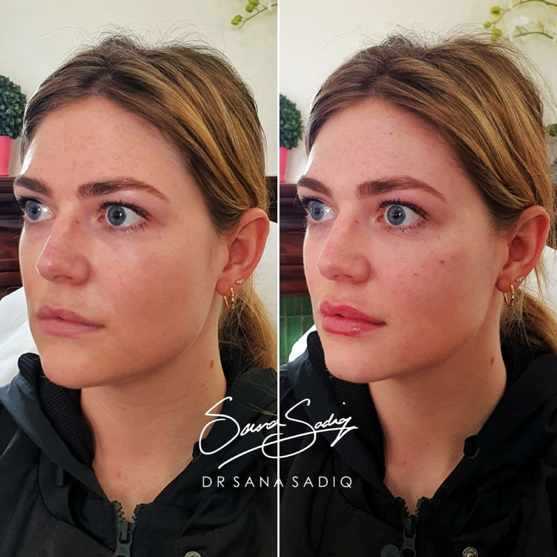 Before and after filler